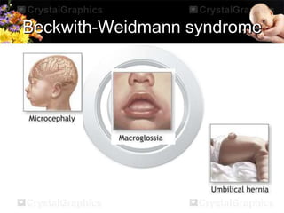 Hypoglycemia in newborns | PPTX