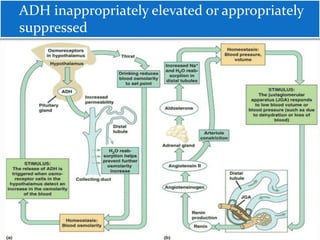 ADH inappropriately elevated or appropriately
suppressed
 