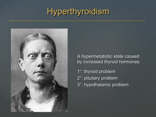 A hypermetabolic state causedA hypermetabolic state caused
by increased thyroid hormones.by increased thyroid hormones.
1°: thyroid problem1°: thyroid problem
2°: pituitary problem2°: pituitary problem
3°: hypothalamic problem3°: hypothalamic problem
HyperthyroidismHyperthyroidism
 
