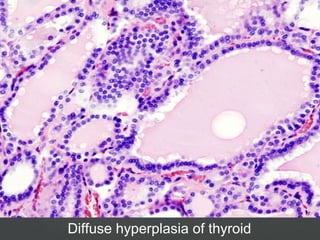 Diffuse hyperplasia of thyroid
 
