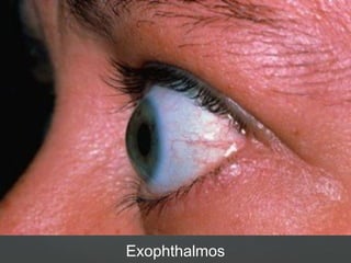 Exophthalmos
 