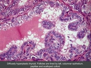 Diffusely hyperplastic thyroid. Follicles are lined by tall, columnar epithelium.
papillae and scalloped colloid
 