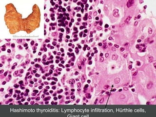 Hashimoto thyroiditis: Lymphocyte infiltration, Hürthle cells,
 