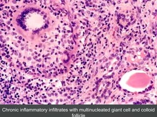 Chronic inflammatory infiltrates with multinucleated giant cell and colloid
 