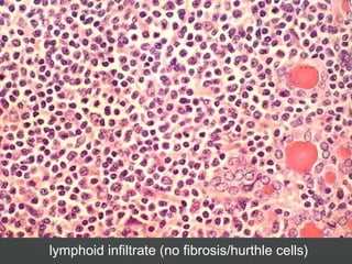 lymphoid infiltrate (no fibrosis/hurthle cells)
 