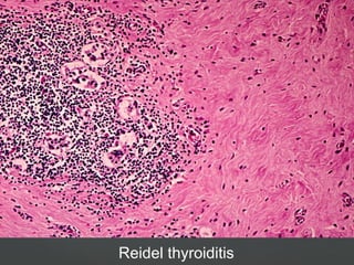 Reidel thyroiditis
 