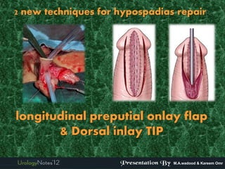 2 new techniques for hypospadias repair:




longitudinal preputial onlay flap
       & Dorsal inlay TIP

                                M.A.wadood & Kareem Omr
 