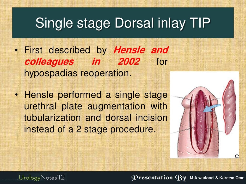 Hypospadias 2 new techniques longitudinal preputial flap & singlest…