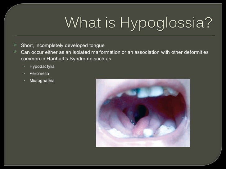 Hypoglossia