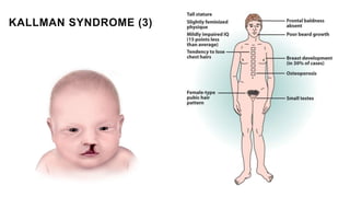 KALLMAN SYNDROME (3)
 