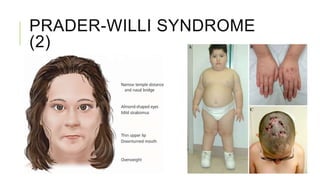 PRADER-WILLI SYNDROME
(2)
 