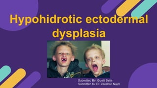 Hypohidrotic ectodermal
dysplasia
Submitted By: Gunjit Setia
Submitted to: Dr. Zeeshan Najm
 