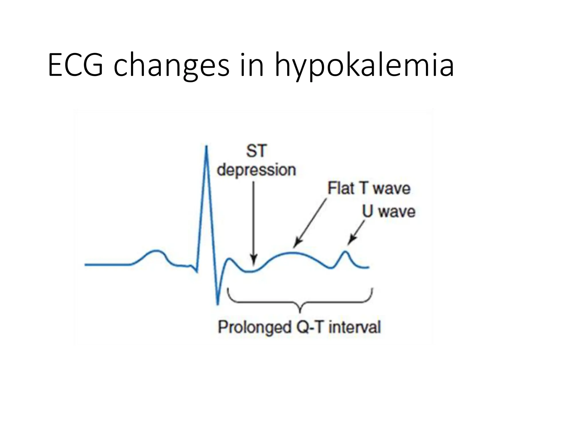 Hypokalemia presentation cause and treatment | PPTX