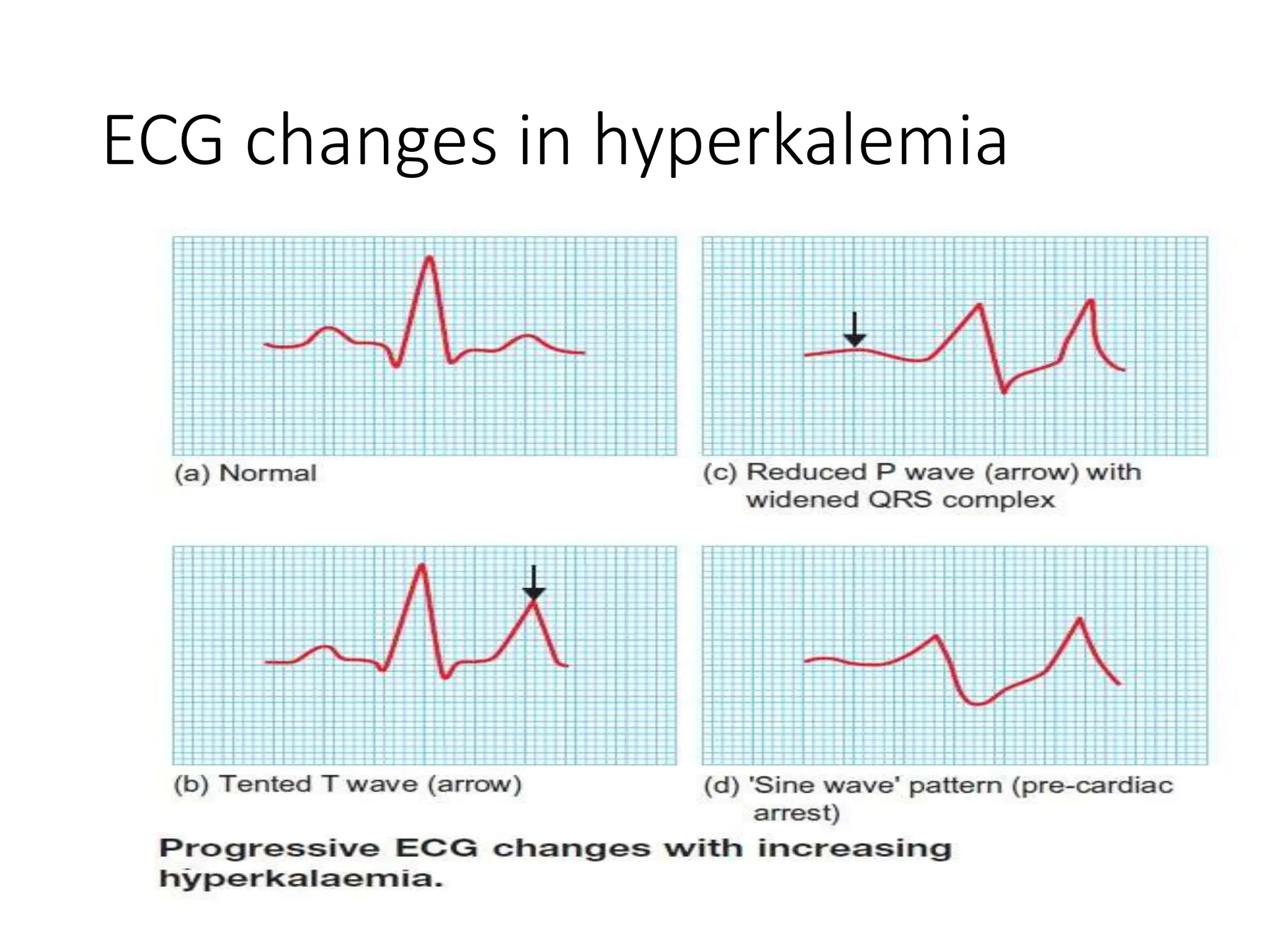 Hypokalemia presentation cause and treatment | PPTX