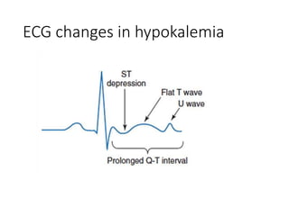 Hypokalemia presentation cause and treatment | PPTX