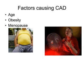Factors causing CAD
• Age
• Obesity
• Menopause
 