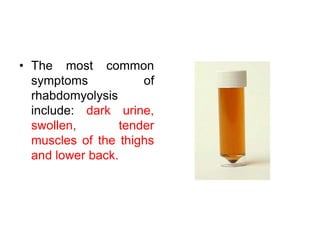 • The most common
symptoms of
rhabdomyolysis
include: dark urine,
swollen, tender
muscles of the thighs
and lower back.
 