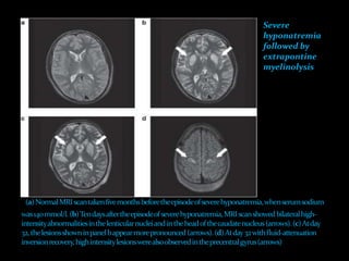 Severe
hyponatremia
followed by
extrapontine
myelinolysis
 