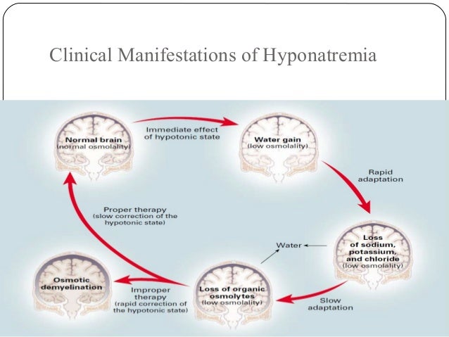 Hyponatremia Ppt Final