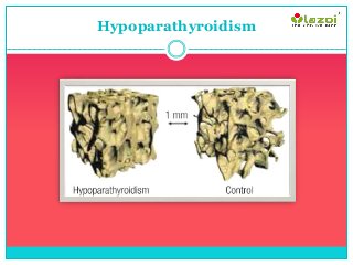 Hypoparathyroidism
 