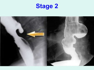 Stylalgia Hypopharyngeal pouch & stylalgia ent .ppt