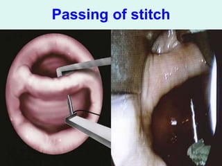 Stylalgia Hypopharyngeal pouch & stylalgia ent .ppt