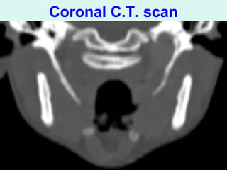 Stylalgia Hypopharyngeal pouch & stylalgia ent .ppt