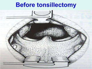 Stylalgia Hypopharyngeal pouch & stylalgia ent .ppt