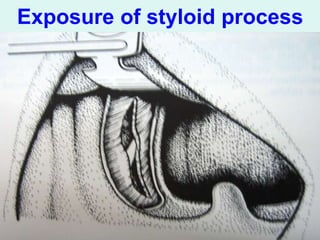 Stylalgia Hypopharyngeal pouch & stylalgia ent .ppt