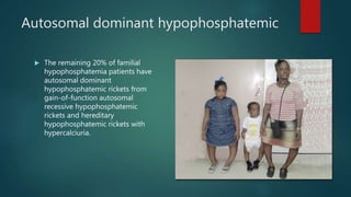 Autosomal dominant hypophosphatemic
 The remaining 20% of familial
hypophosphatemia patients have
autosomal dominant
hypophosphatemic rickets from
gain-of-function autosomal
recessive hypophosphatemic
rickets and hereditary
hypophosphatemic rickets with
hypercalciuria.
 