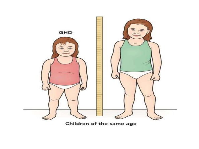 Hypopituitarism