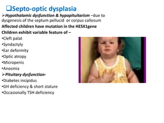Septo-optic dysplasia
Hypothalamic dysfunction & hypopituitarism –due to
dysgenesis of the septum pellucid or corpus callosum
Affected children have mutation in the HESX1gene
Children exhibit variable feature of –
•Cleft palat
•Syndactyly
•Ear deformity
•Optic atropy
•Micropenis
•Anosmia
Pituitary dysfunction-
•Diabetes insipidus
•GH deficiency & short stature
•Occasionally TSH deficiency
 