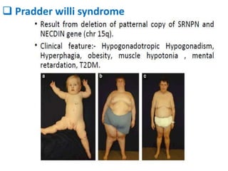  Pradder willi syndrome
 