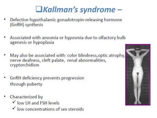 Kallman’s syndrome –
 