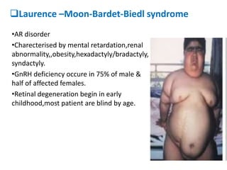 Laurence –Moon-Bardet-Biedl syndrome
•AR disorder
•Charecterised by mental retardation,renal
abnormality,,obesity,hexadactyly/bradactyly,
syndactyly.
•GnRH deficiency occure in 75% of male &
half of affected females.
•Retinal degeneration begin in early
childhood,most patient are blind by age.
 