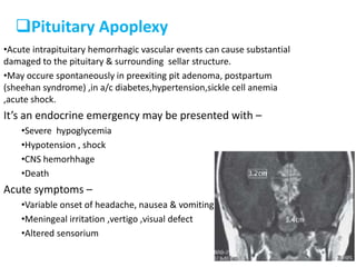 Pituitary Apoplexy
•Acute intrapituitary hemorrhagic vascular events can cause substantial
damaged to the pituitary & surrounding sellar structure.
•May occure spontaneously in preexiting pit adenoma, postpartum
(sheehan syndrome) ,in a/c diabetes,hypertension,sickle cell anemia
,acute shock.
It’s an endocrine emergency may be presented with –
•Severe hypoglycemia
•Hypotension , shock
•CNS hemorhhage
•Death
Acute symptoms –
•Variable onset of headache, nausea & vomiting,
•Meningeal irritation ,vertigo ,visual defect
•Altered sensorium
 