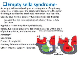 Empty sella syndrome-
 