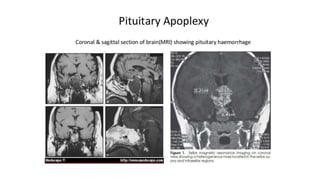 Hypopituitarism