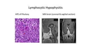 Hypopituitarism