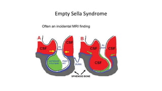Hypopituitarism