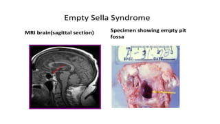 Hypopituitarism