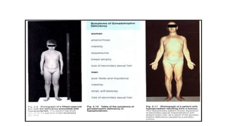 Hypopituitarism