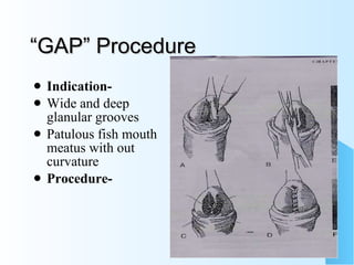 “GAP” Procedure Indication- Wide and deep glanular grooves Patulous fish mouth meatus with out curvature Procedure- 