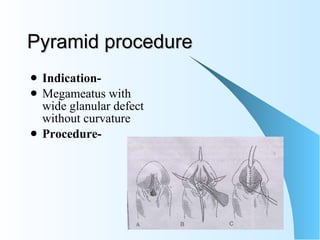 Pyramid procedure Indication- Megameatus with wide glanular defect without curvature Procedure- 