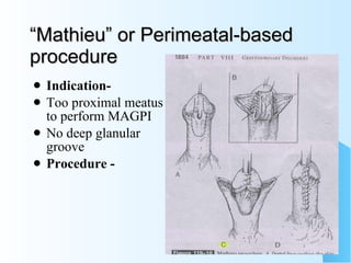 “ Mathieu” or Perimeatal-based procedure Indication-  Too proximal meatus to perform MAGPI No deep glanular groove  Procedure - 