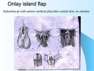 Onlay island flap Indication-pt with narrow urethral plate,thin ventral skin, no chordee 
