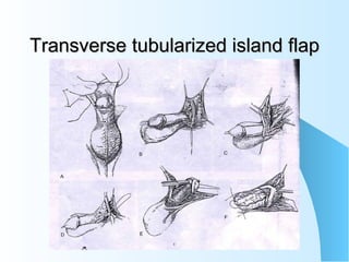Transverse tubularized island flap 