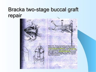 Bracka two-stage buccal graft repair 