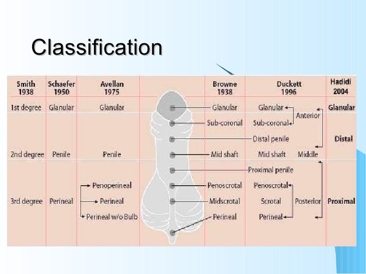 Epispadias And Hypospadias Approach To The Adult Hypospadias Patient Epispadias And Hypospadias Approach To The Adult Hypospadias Patient