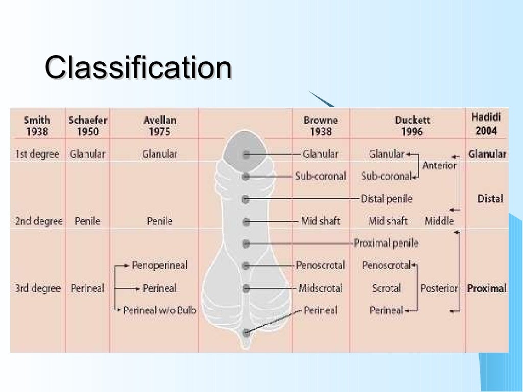 Hypospadias
